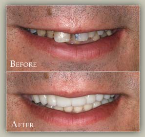 Full Mouth Reconstruction 2 and Porcelain Crowns