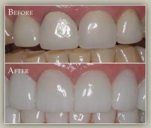 New Porcelain Crowns