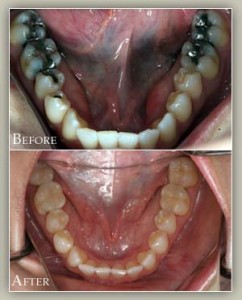 Replace Metal Fillings 1