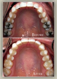 Replace Metal Fillings 2