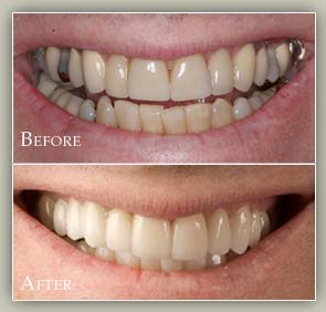Replacing Old Veneers - Brad