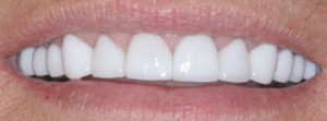 Patient teeth after picture